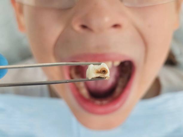 Best Knocked-Out Tooth (Avulsed Tooth) Treatment in Baywood, NY
